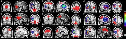 Disrupted Functional Connectivity Within and Between Resting-State Networks in the Subacute Stage of Post-stroke Aphasia